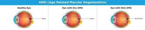AMD eye health